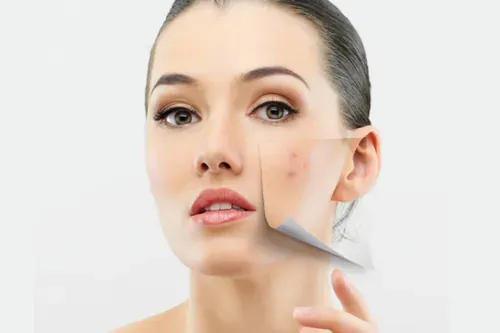 Anti acne im.jpg